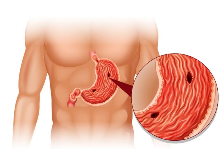 ọnyá afọ dị ka ihe na-akpata mgbu n'okpuru scapula ekpe n'azụ