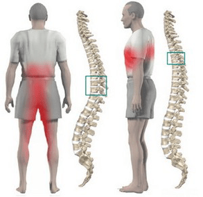 azụ mgbu na thoracic osteochondrosis