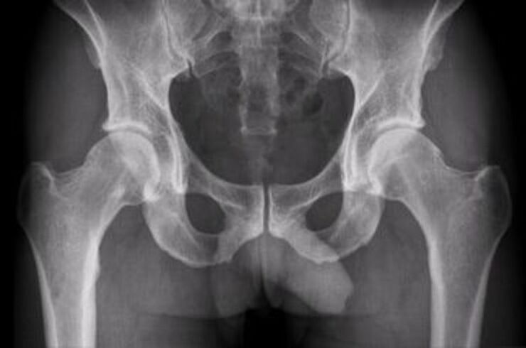 x-ray nke nkwonkwo hip maka mgbu