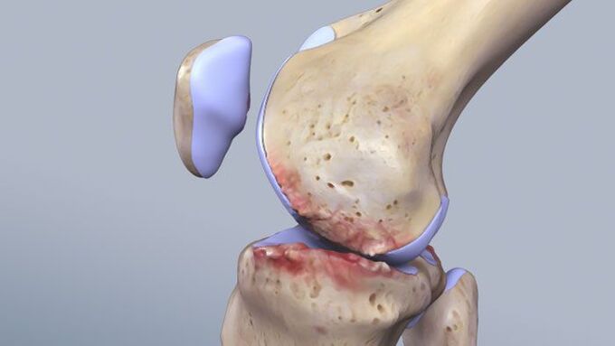 Ọdịdị nke nkwonkwo ikpere na-emetụta pathology