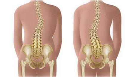 Na-abụghị scoliosis