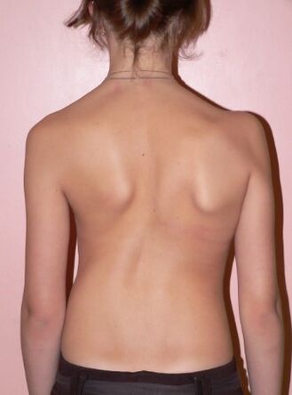 Scoliosis 2