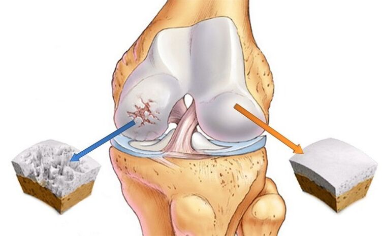 A na-arthrosis metụtara