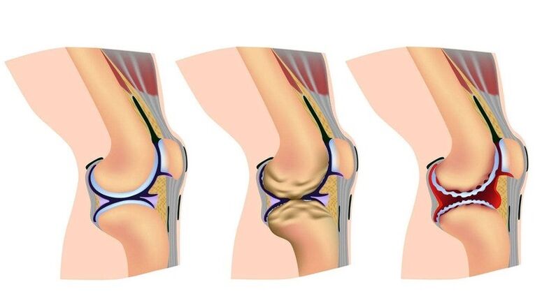 Sterations nke nrụrụ na nkwonkwo ikpere maka akpịrị