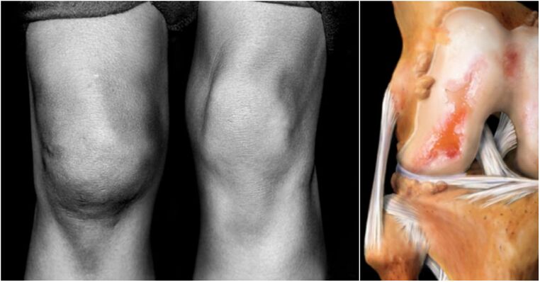 arthrosis nke nkwonkwo ikpere na nkwonkwo ụkwụ