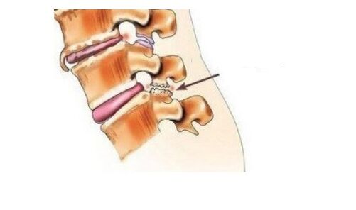 Spondyloarthrosis na-ebute azụ mgbu