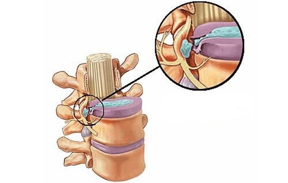 intervertebral hernia na thoracic osteochondrosis