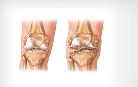 arthrosis nke nkwonkwo ikpere