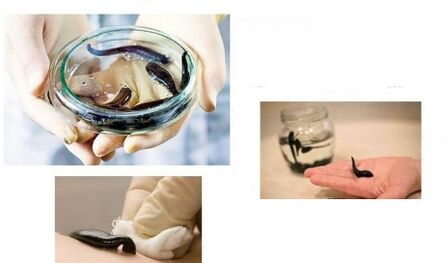 hirudotherapy maka arthrosis