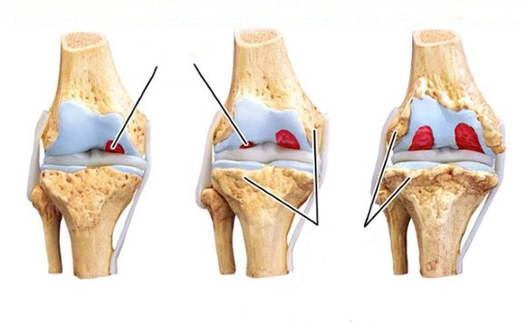 ogbo nke ikpere arthrosis