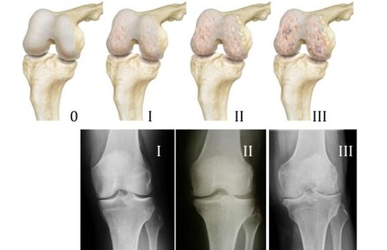 usoro maka ịchọpụta arthrosis ikpere